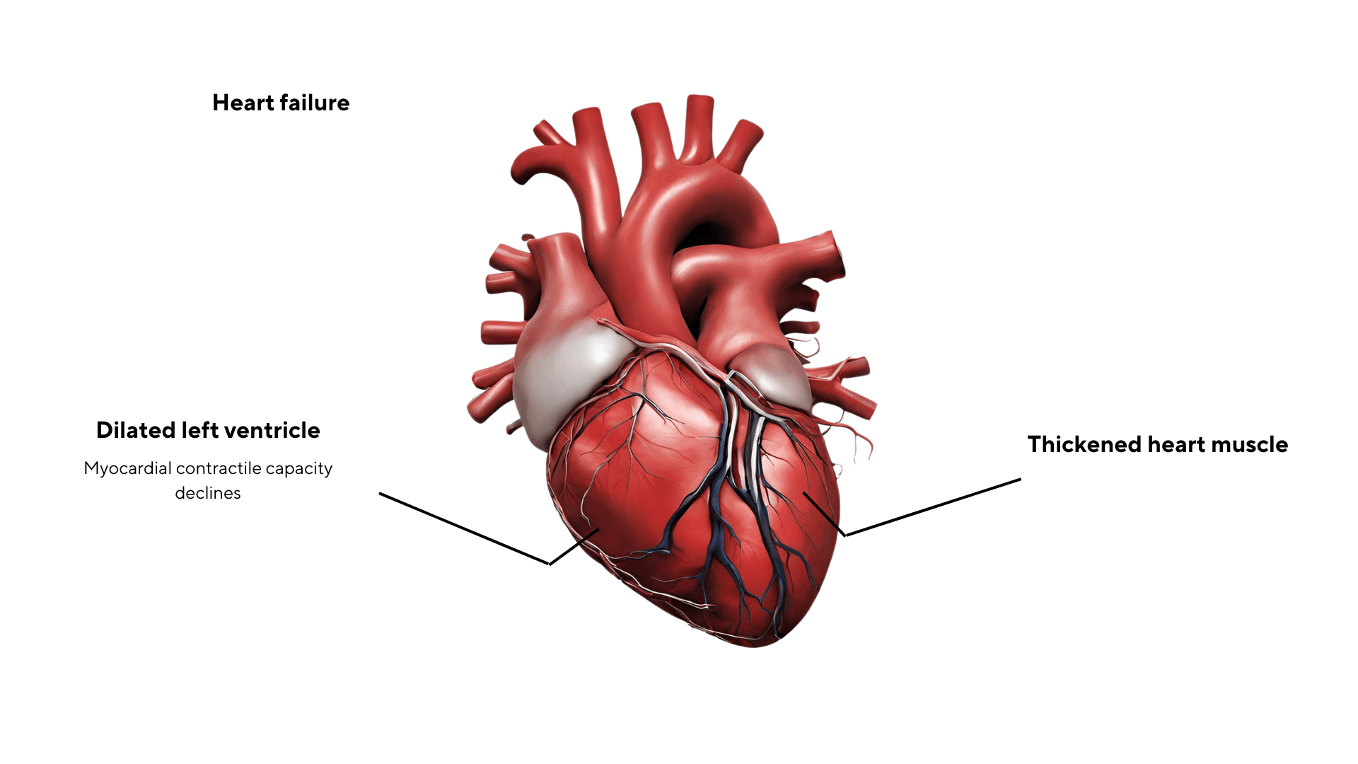 heart in heart failure